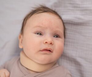 baby with torticollis