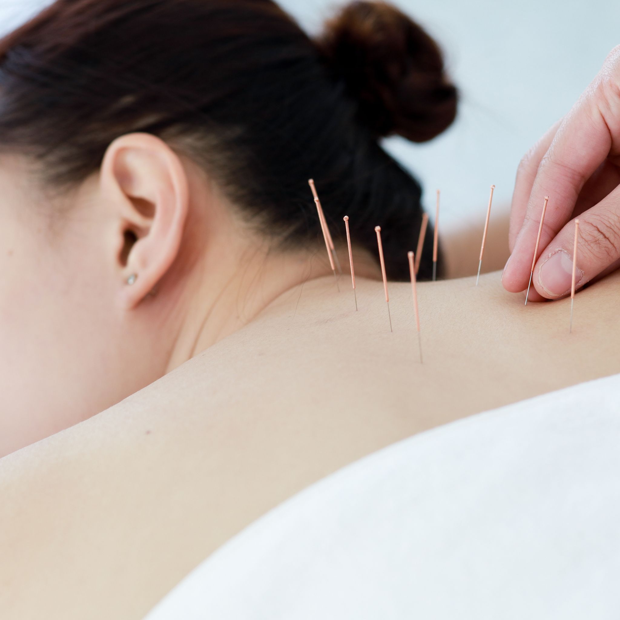 dry needling alongside physical therapy